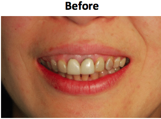 Before: A More Natural Look